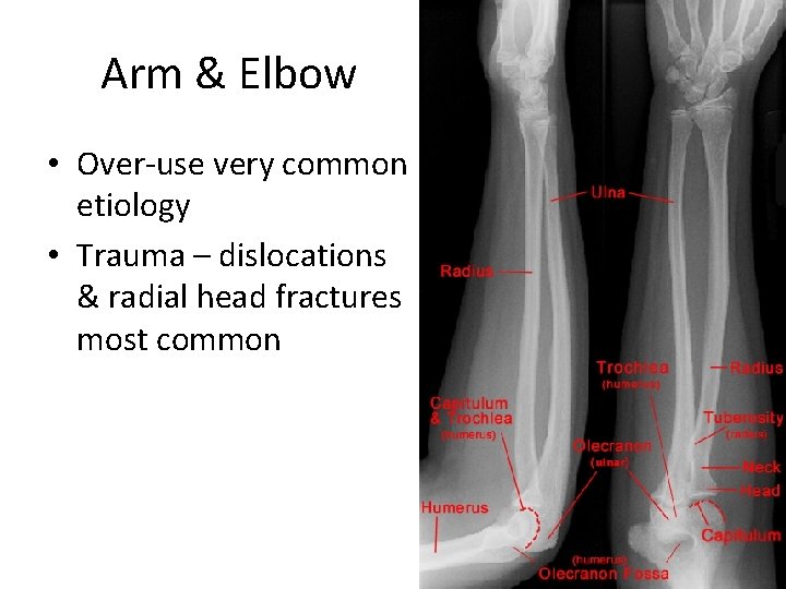 Arm & Elbow • Over-use very common etiology • Trauma – dislocations & radial