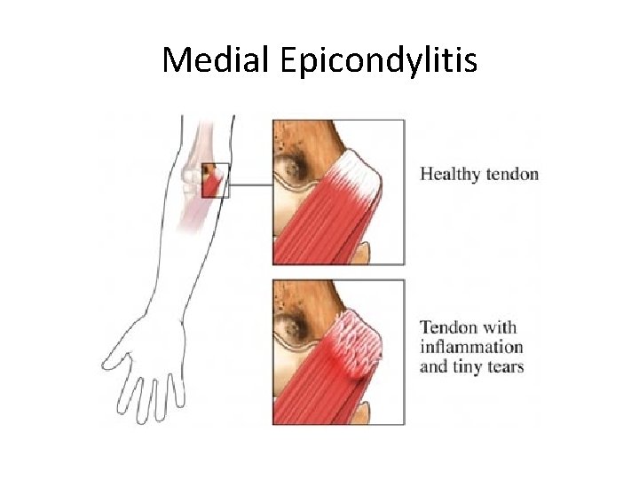 Medial Epicondylitis 