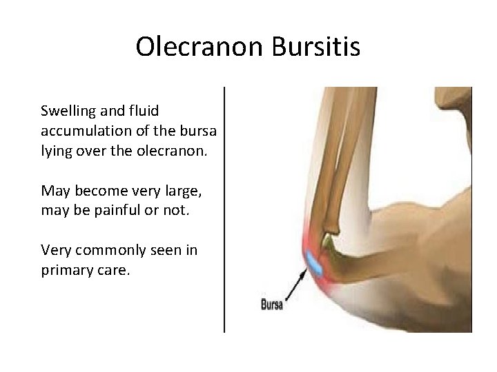 Olecranon Bursitis Swelling and fluid accumulation of the bursa lying over the olecranon. May