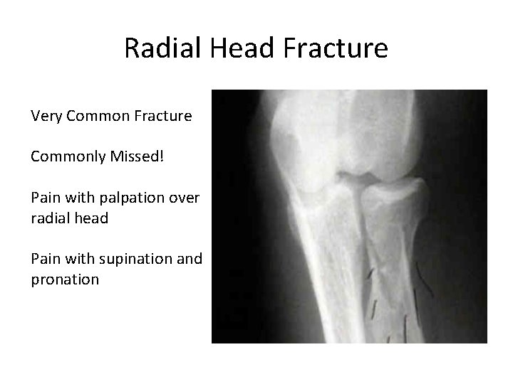 Radial Head Fracture Very Common Fracture Commonly Missed! Pain with palpation over radial head