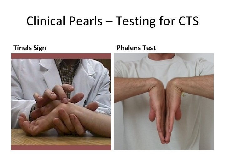 Clinical Pearls – Testing for CTS Tinels Sign Phalens Test 