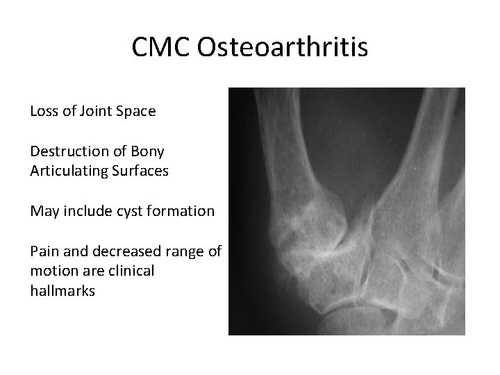 CMC Osteoarthritis Loss of Joint Space Destruction of Bony Articulating Surfaces May include cyst
