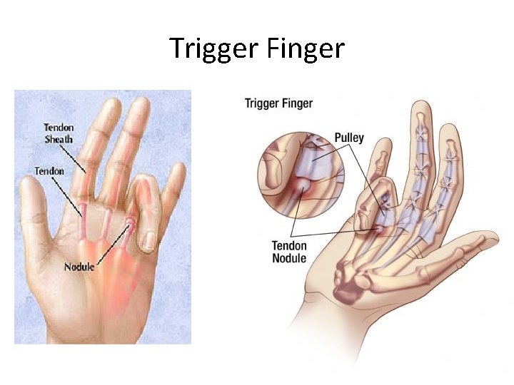 Trigger Finger 
