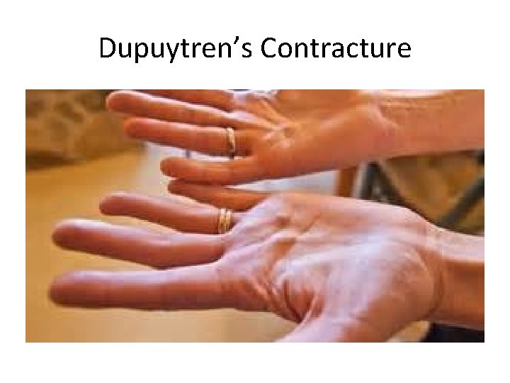 Dupuytren’s Contracture 
