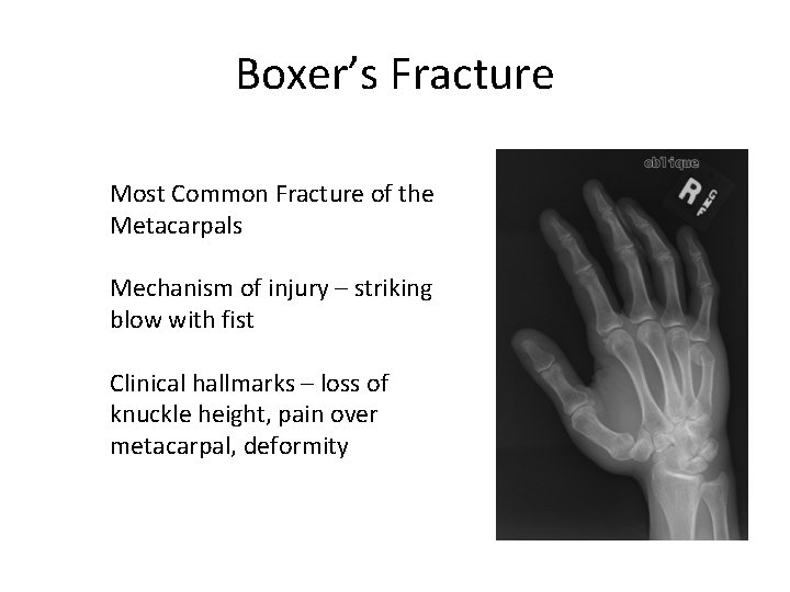 Boxer’s Fracture Most Common Fracture of the Metacarpals Mechanism of injury – striking blow