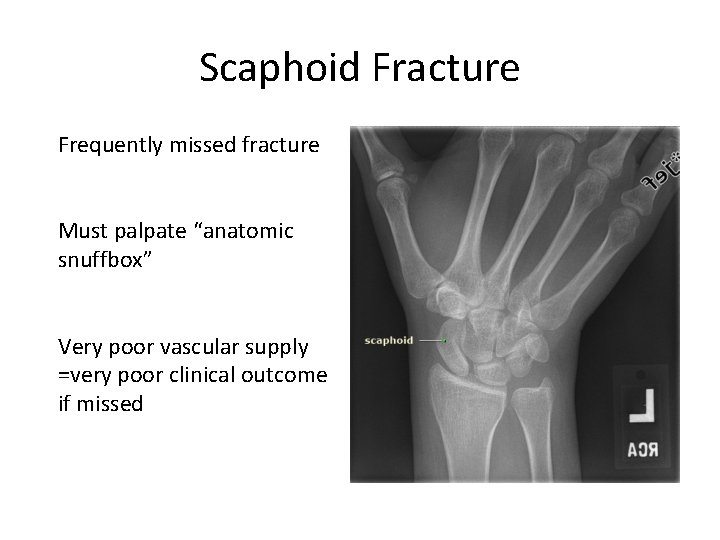 Scaphoid Fracture Frequently missed fracture Must palpate “anatomic snuffbox” Very poor vascular supply =very