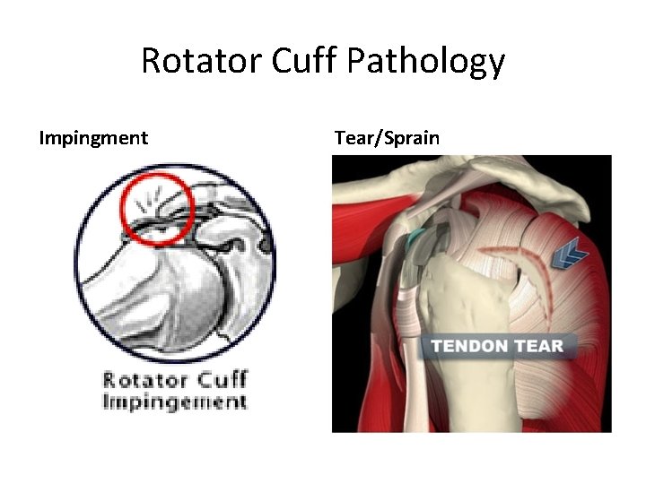 Rotator Cuff Pathology Impingment Tear/Sprain 