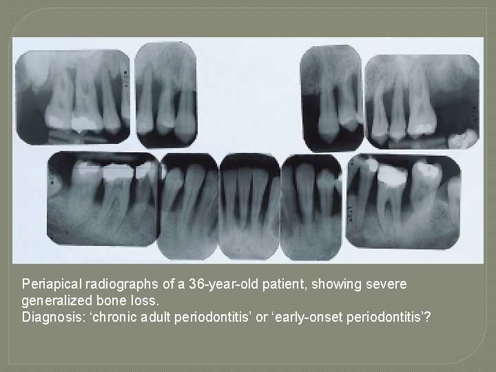 Periapical radiographs of a 36 -year-old patient, showing severe generalized bone loss. Diagnosis: ‘chronic