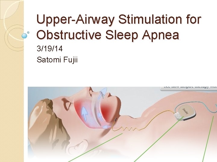 Upper-Airway Stimulation for Obstructive Sleep Apnea 3/19/14 Satomi Fujii 