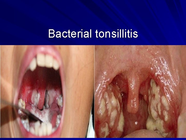 Bacterial tonsillitis 