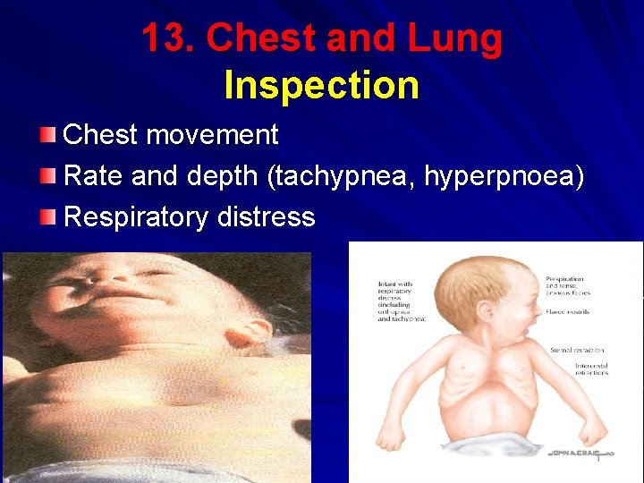 13. Chest and Lung Inspection Chest movement Rate and depth (tachypnea, hyperpnoea) Respiratory distress
