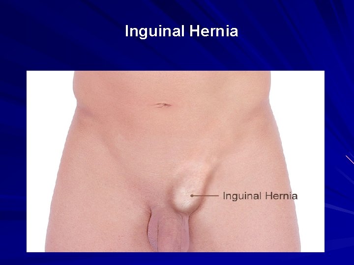 Inguinal Hernia 