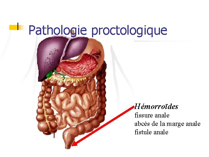 Pathologie proctologique Hémorroïdes fissure anale abcès de la marge anale fistule anale 