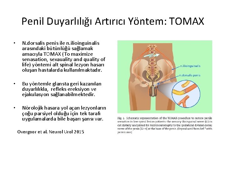 Penil Duyarlılığı Artırıcı Yöntem: TOMAX • N. dorsalis penis ile n. ilioinguinalis arasındaki bütünlüğü