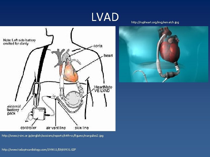 LVAD http: //www. j-circ. or. jp/english/sessions/reports/64 th-ss/figures/margulies 2. jpg http: //www. todayincardiology. com/199811/S 8