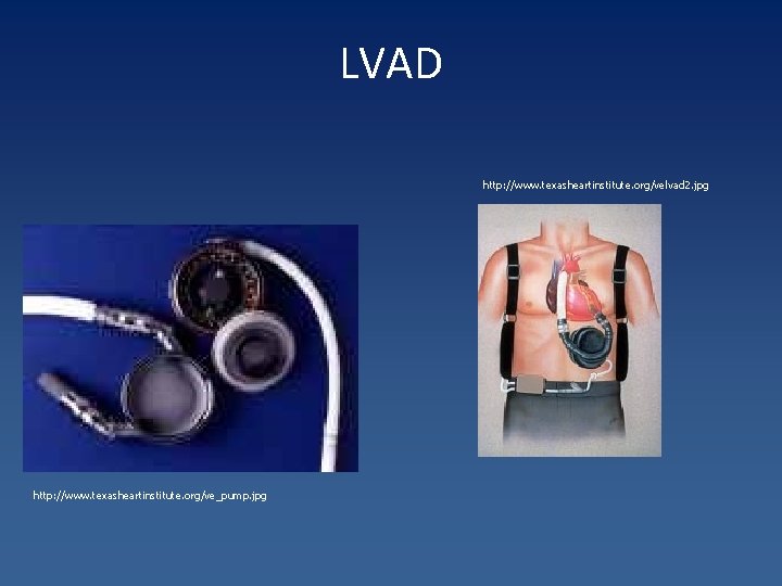 LVAD http: //www. texasheartinstitute. org/velvad 2. jpg http: //www. texasheartinstitute. org/ve_pump. jpg 