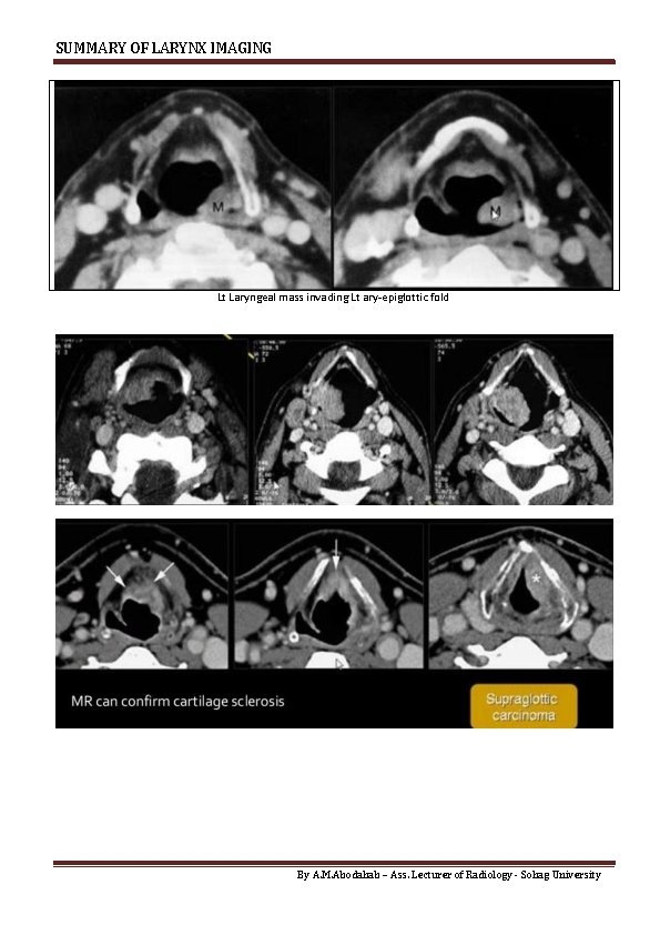 SUMMARY OF LARYNX IMAGING Lt Laryngeal mass invading Lt ary-epiglottic fold By A. M.