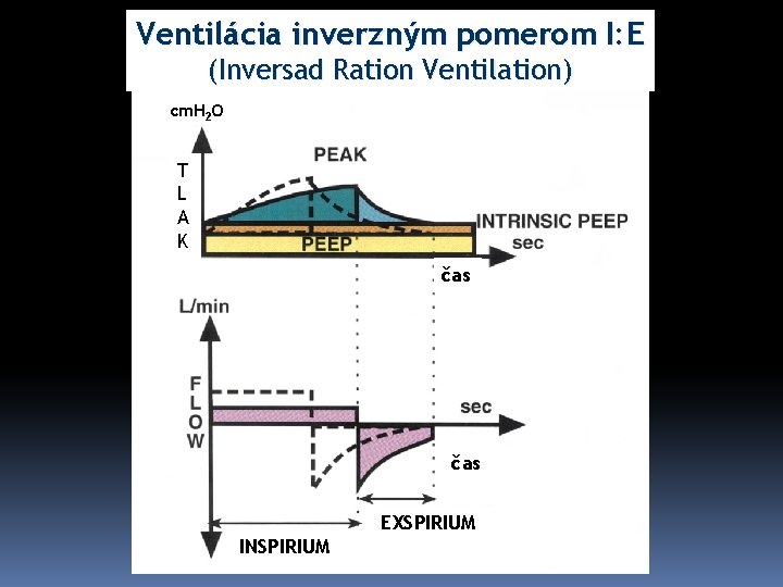 Ventilácia inverzným pomerom I: E (Inversad Ration Ventilation) cm. H 2 O T L