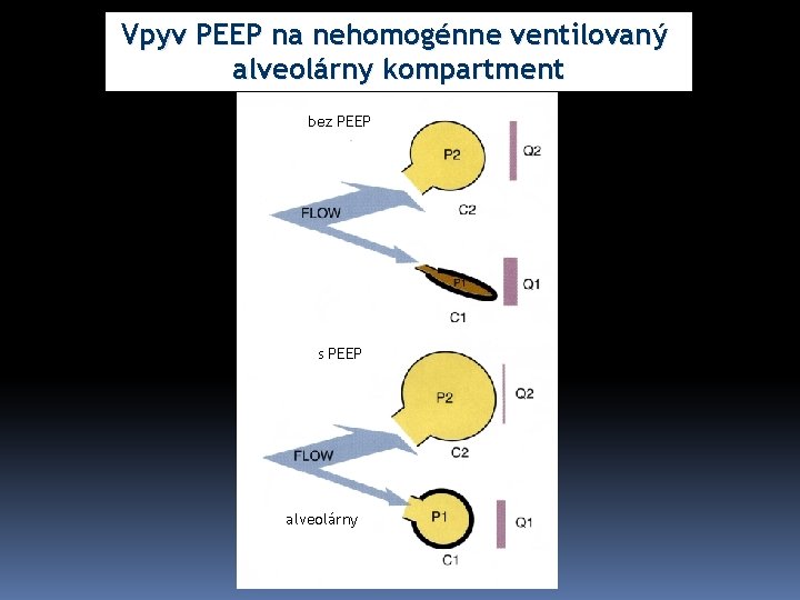 Vpyv PEEP na nehomogénne ventilovaný alveolárny kompartment bez PEEP s PEEP alveolárny 