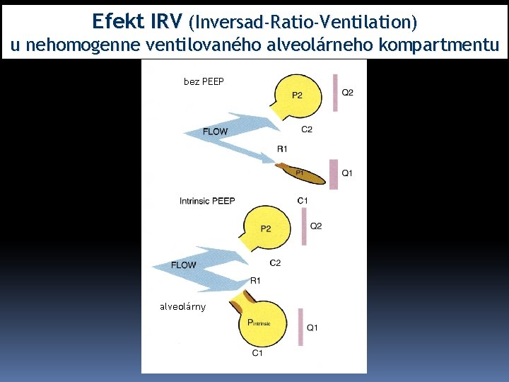 Efekt IRV (Inversad-Ratio-Ventilation) u nehomogenne ventilovaného alveolárneho kompartmentu bez PEEP alveolárny 