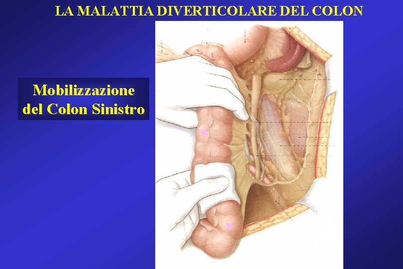 LA MALATTIA DIVERTICOLARE DEL COLON Mobilizzazione del Colon Sinistro LA MALATTIA DIVERTICOLARE DEL COLON Mobilizzazione del Colon Sinistro
