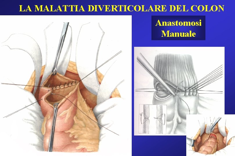 LA MALATTIA DIVERTICOLARE DEL COLON Anastomosi Manuale LA MALATTIA DIVERTICOLARE DEL COLON Anastomosi Manuale