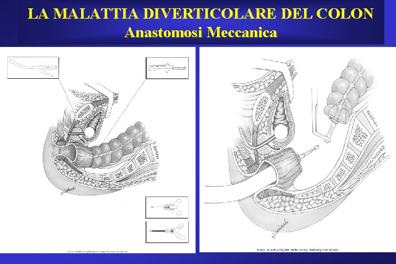 LA MALATTIA DIVERTICOLARE DEL COLON Anastomosi Meccanica LA MALATTIA DIVERTICOLARE DEL COLON Anastomosi Meccanica