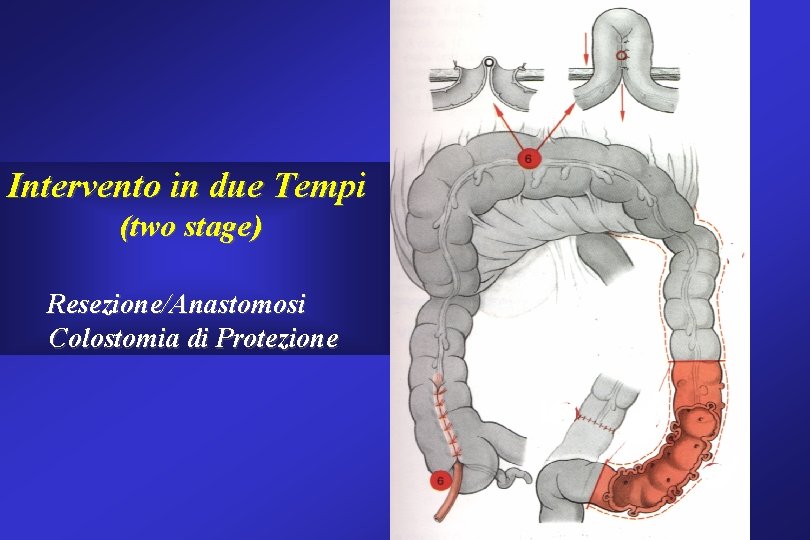 Intervento in due Tempi (two stage) Resezione/Anastomosi Colostomia di Protezione Intervento in due Tempi (two stage) Resezione/Anastomosi Colostomia di Protezione