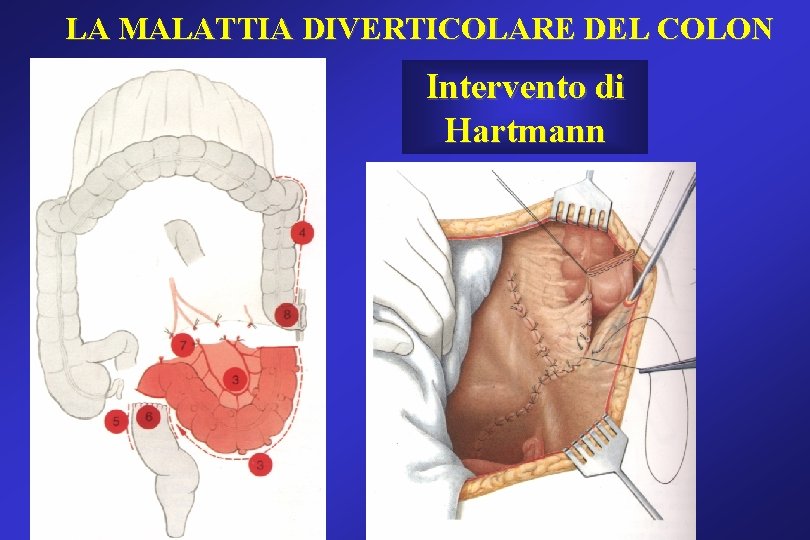 LA MALATTIA DIVERTICOLARE DEL COLON Intervento di Hartmann LA MALATTIA DIVERTICOLARE DEL COLON Intervento di Hartmann