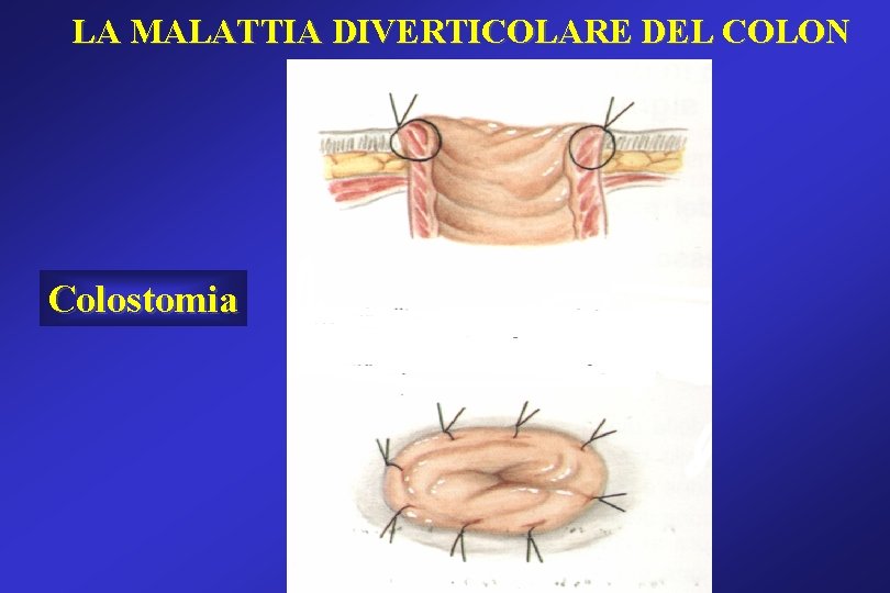 LA MALATTIA DIVERTICOLARE DEL COLON Colostomia LA MALATTIA DIVERTICOLARE DEL COLON Colostomia