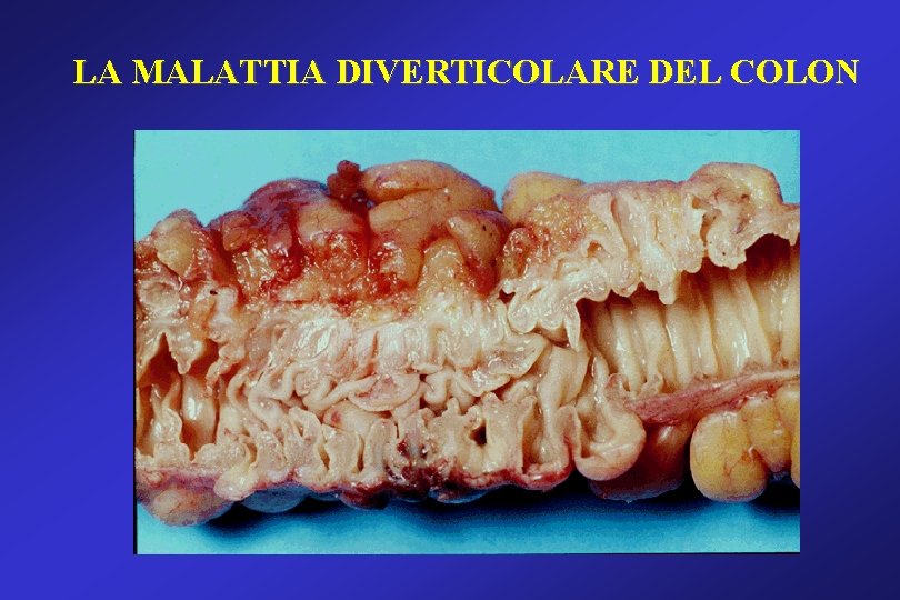 LA MALATTIA DIVERTICOLARE DEL COLON LA MALATTIA DIVERTICOLARE DEL COLON