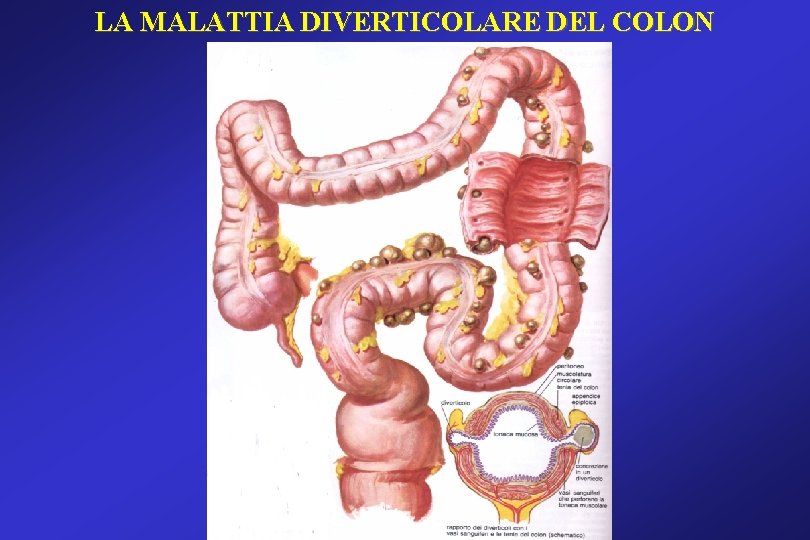 LA MALATTIA DIVERTICOLARE DEL COLON LA MALATTIA DIVERTICOLARE DEL COLON