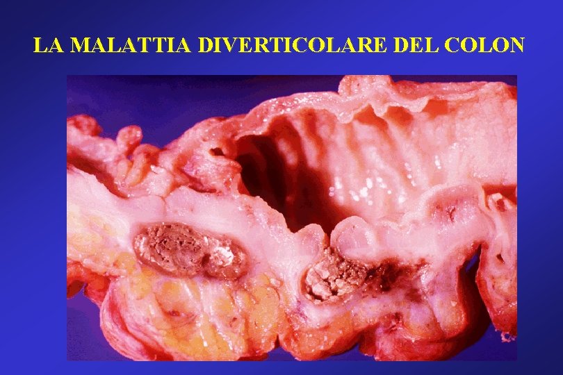LA MALATTIA DIVERTICOLARE DEL COLON LA MALATTIA DIVERTICOLARE DEL COLON