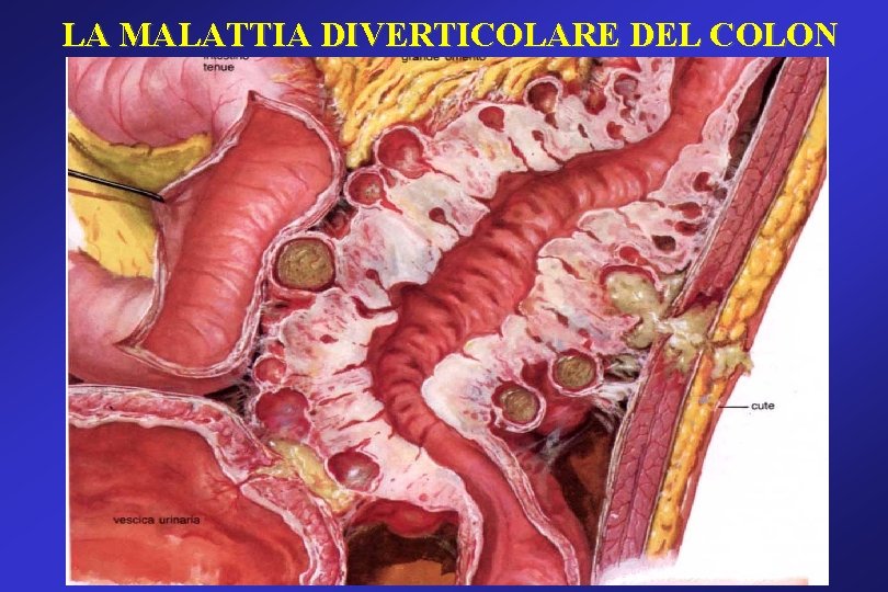 LA MALATTIA DIVERTICOLARE DEL COLON LA MALATTIA DIVERTICOLARE DEL COLON