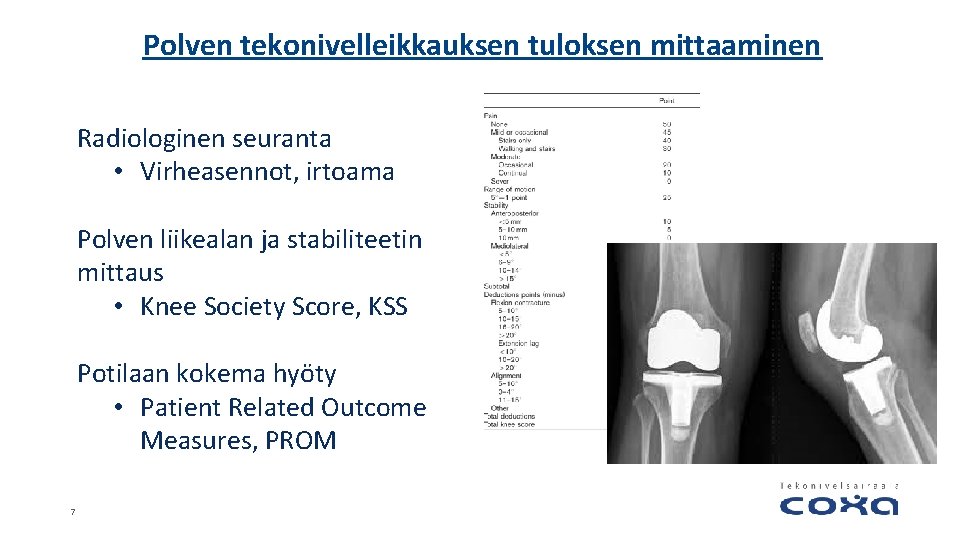 Polven tekonivelleikkauksen tuloksen mittaaminen Radiologinen seuranta • Virheasennot, irtoama Polven liikealan ja stabiliteetin mittaus