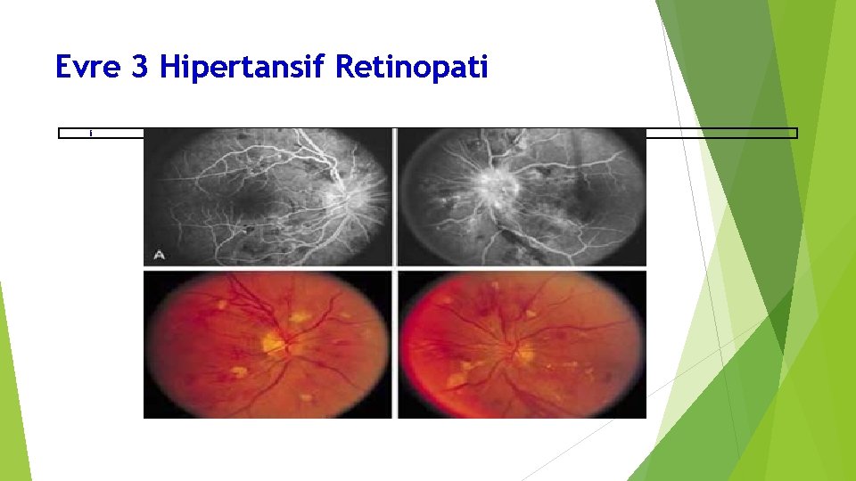 Evre 3 Hipertansif Retinopati i 