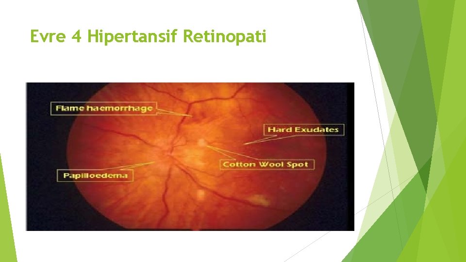 Evre 4 Hipertansif Retinopati 