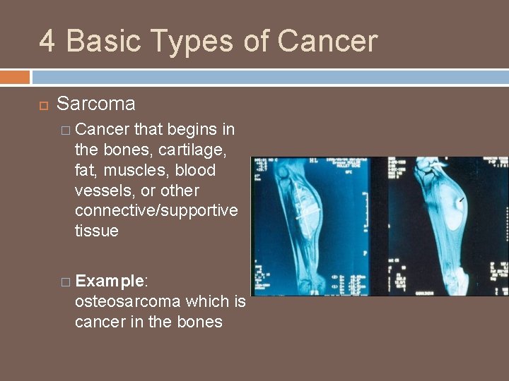 4 Basic Types of Cancer Sarcoma � Cancer that begins in the bones, cartilage,