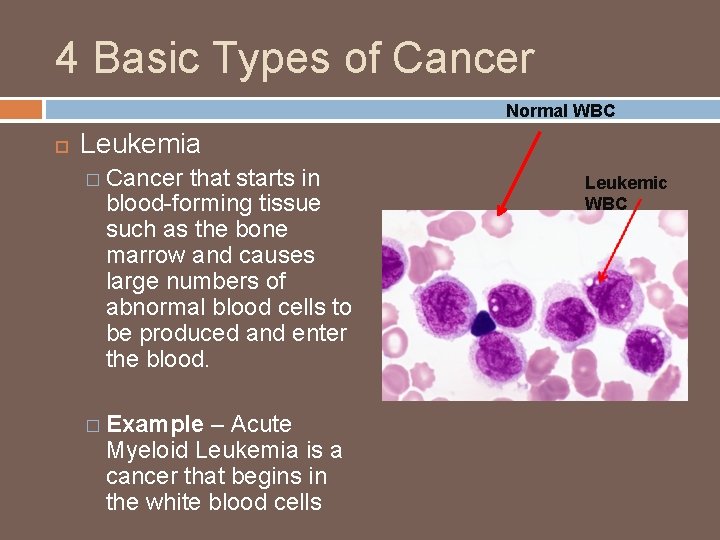 4 Basic Types of Cancer Normal WBC Leukemia � Cancer that starts in blood-forming