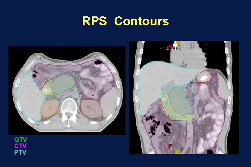 RPS Contours GTV CTV PTV 