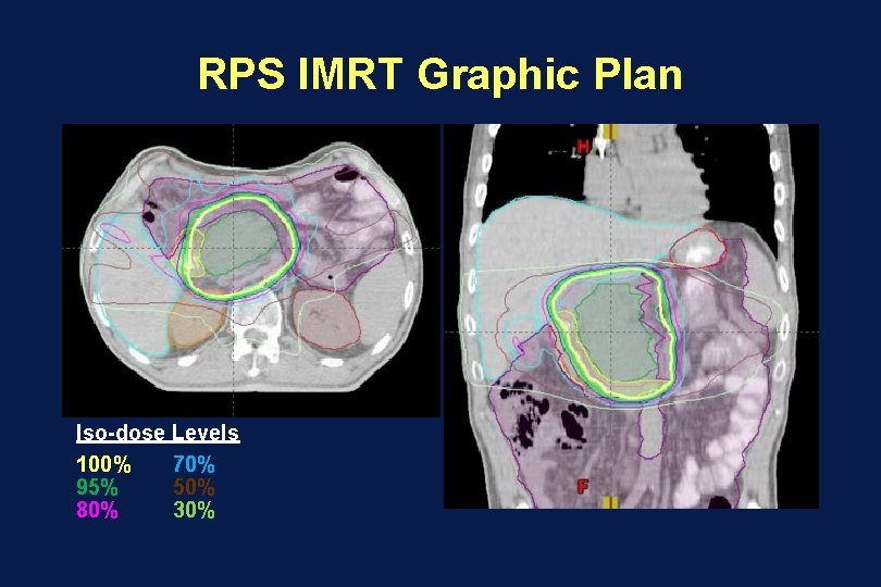 RPS IMRT Graphic Plan Iso-dose Levels 100% 70% 95% 50% 80% 30% 