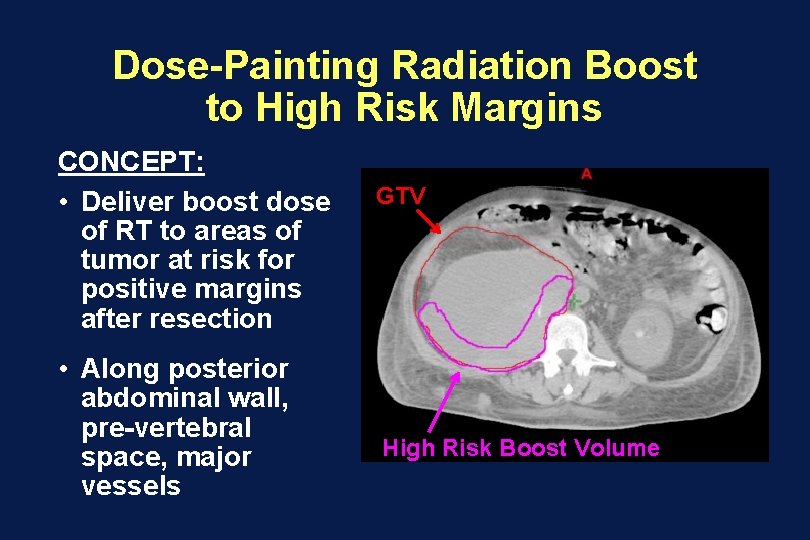 Dose-Painting Radiation Boost to High Risk Margins CONCEPT: • Deliver boost dose of RT