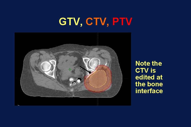 GTV, CTV, PTV Note the CTV is edited at the bone interface 