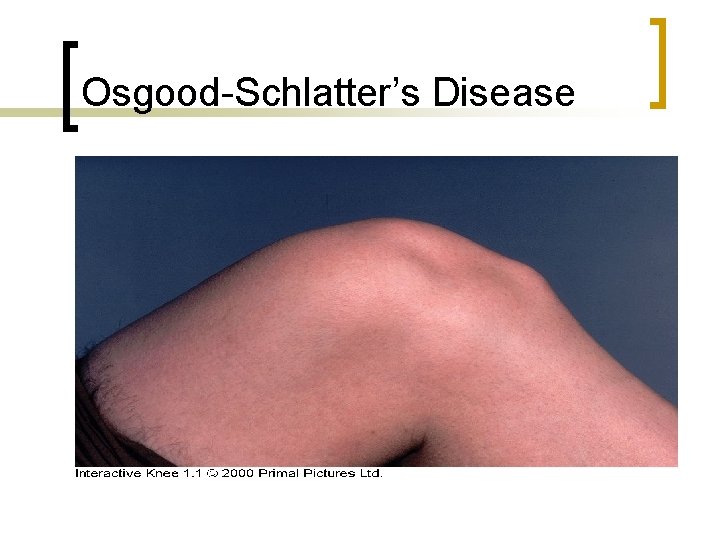 Osgood-Schlatter’s Disease 