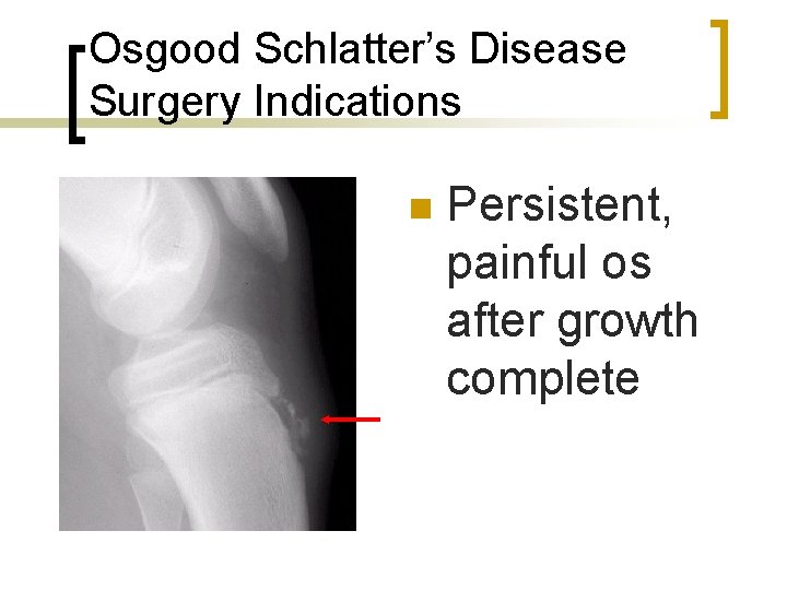 Osgood Schlatter’s Disease Surgery Indications n Persistent, painful os after growth complete 