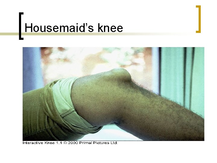 Housemaid’s knee 