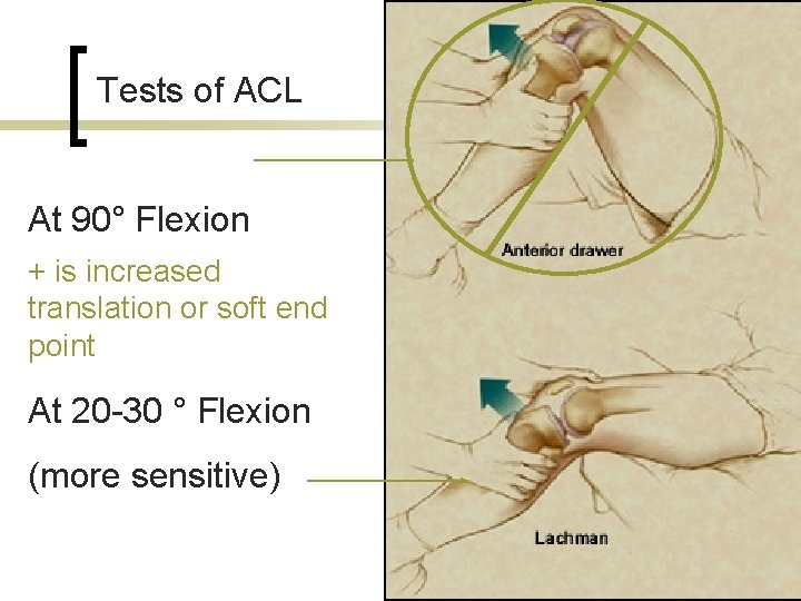 Tests of ACL At 90° Flexion + is increased translation or soft end point