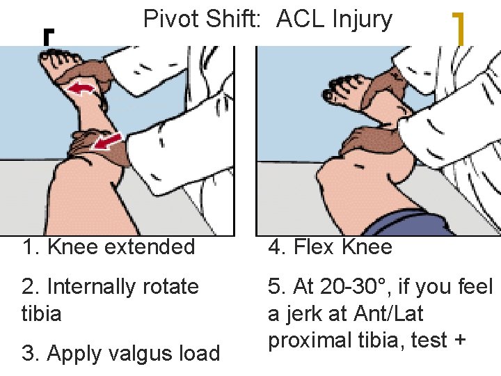 Pivot Shift: ACL Injury 1. Knee extended 4. Flex Knee 2. Internally rotate tibia