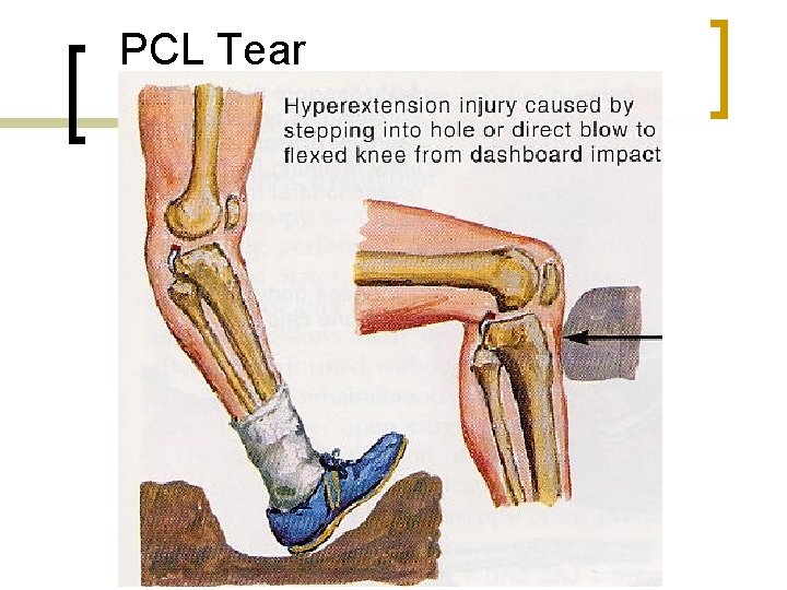 PCL Tear 