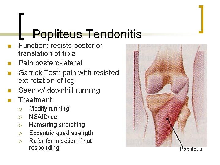 Popliteus Tendonitis n n n Function: resists posterior translation of tibia Pain postero-lateral Garrick